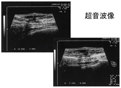 初診時の超音波検査の画像